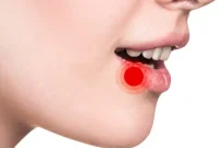 “روش‌های خانگی موثر برای درمان سه سوته آفت دهان”