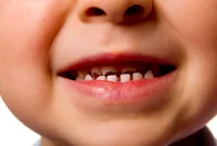 **راهکارهای موثر برای حذف لکه‌های سیاه از دندان کودک در محیط خانگی**