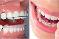 پلاک دندان: علت و عوارض آن