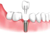 مقایسه ایمپلنت و لمینت: کدام بهتر است؟