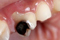 چرا دندان‌ها پوسیده می‌شوند؟