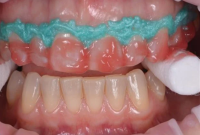 تفاوت بلیچینگ دندان با سایر روش‌های دندانپزشکی و تمام جوانب آن