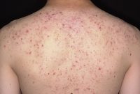 آکنه و جوش روی شانه و بازو: علائم و علت های احتمالی