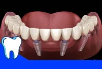 ایمپلنت All On 4: چگونگی کارکرد و تفاوت‌های آن با ایمپلنت معمولی