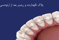 پلاک نگهدارنده و ریتینر: حافظه‌ی زیبایی پس از ارتودنسی