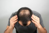 کاشت مو به روش SUT: روشی مدرن و کم تهاجم برای بازیابی موی از دست رفته