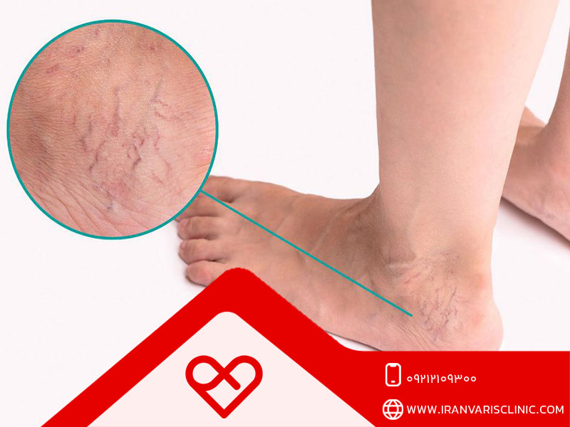 علائم واریس پا