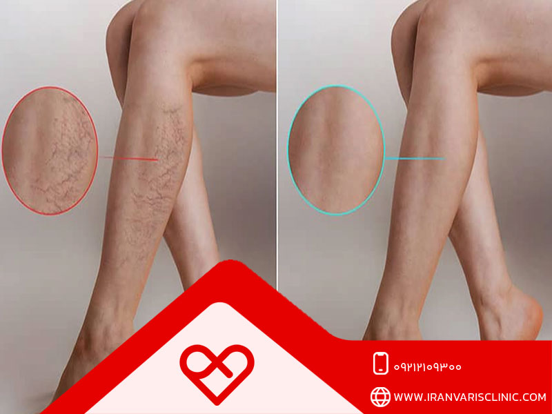 آشنایی با روش های درمان خانگی انواع واریس پا