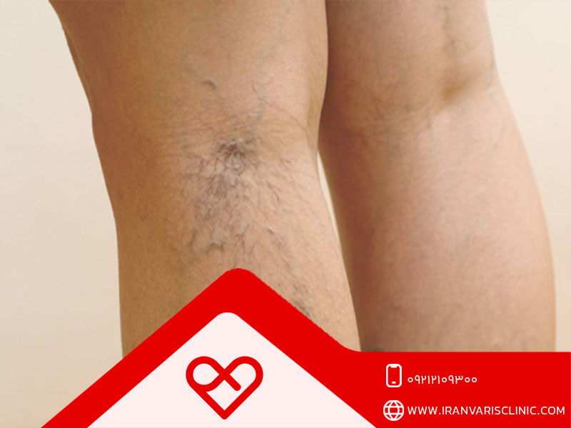 چه زمانی برای درمان واریس به پزشک مراجعه کنیم؟
