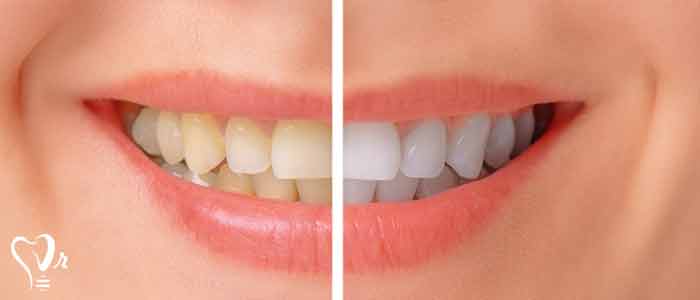 بلیچینگ برای سفید کردن دندان
