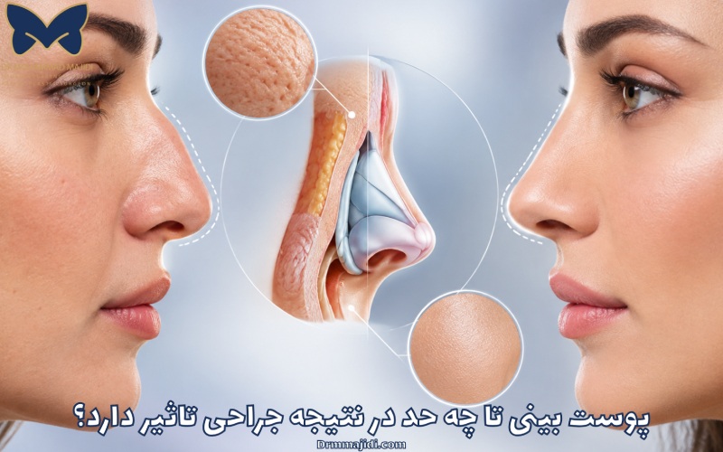 پوست بینی تا چه حد در نتیجه جراحی تاثیر دارد؟