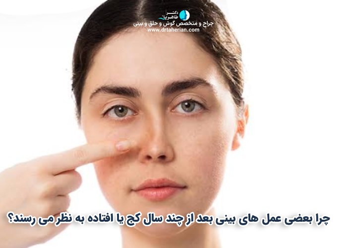 چرا بعضی عمل های بینی بعد از چند سال کج یا افتاده به نظر می رسند؟